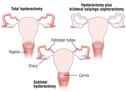 hysterectomy cost india 2019
