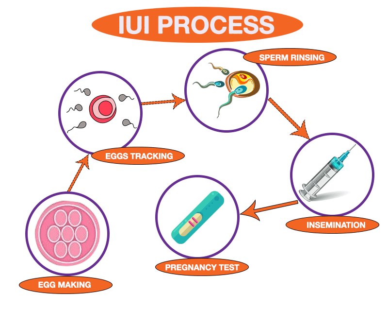 IUI procedure in Philippines 