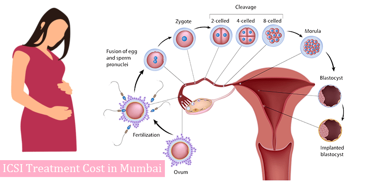 icsi treatment cost in mumbai